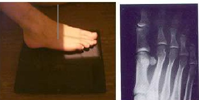 Proyección Oblicua de Dedos del Pie